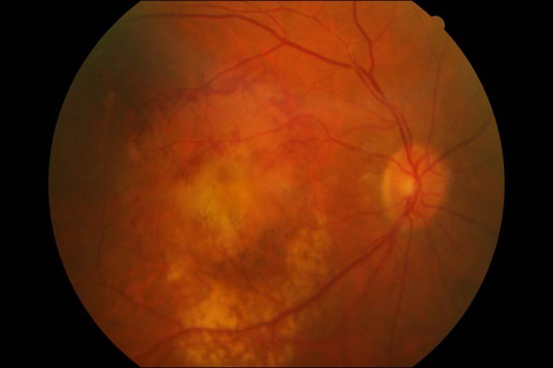 Degeneración macular